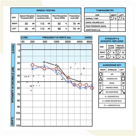 how to read a tympanogram|How to read your hearing test results .